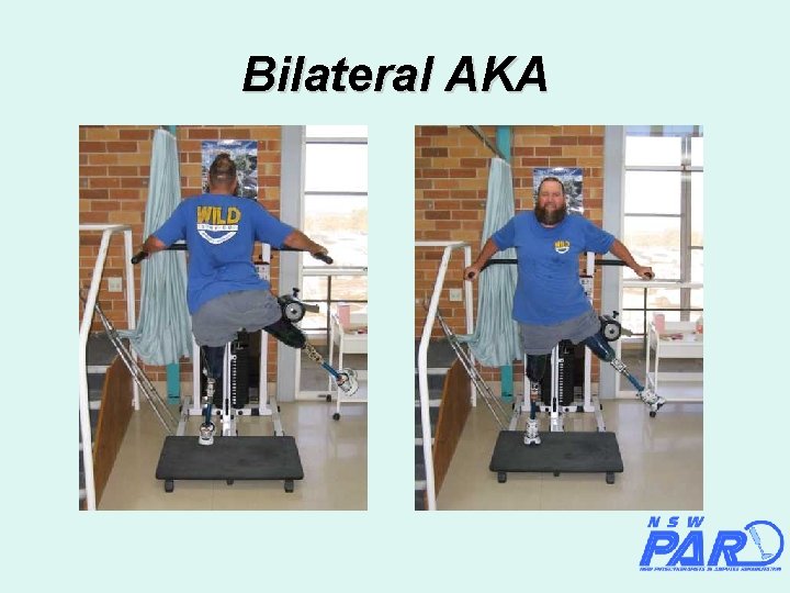 Bilateral AKA 