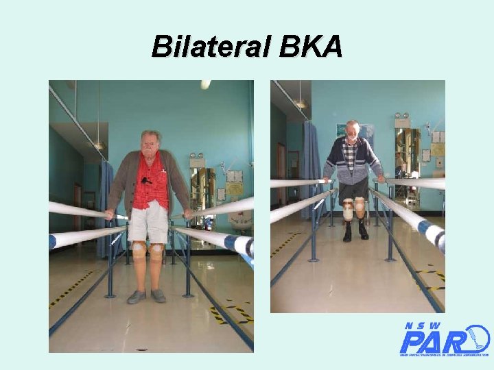Bilateral BKA 