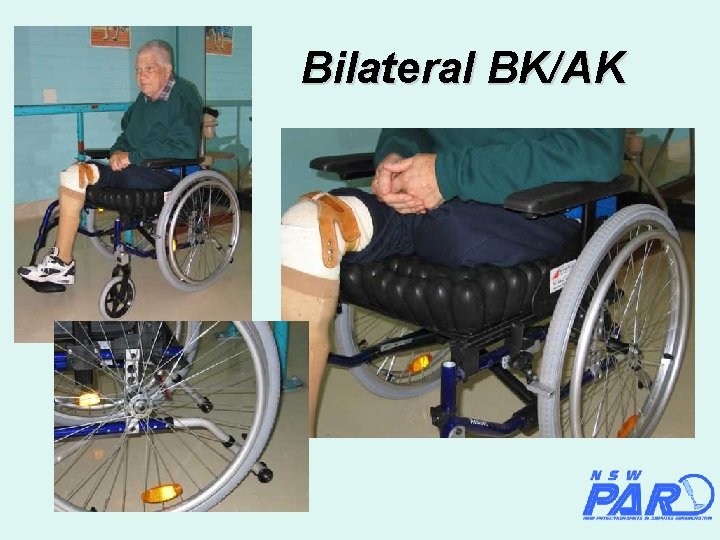 Bilateral BK/AK 