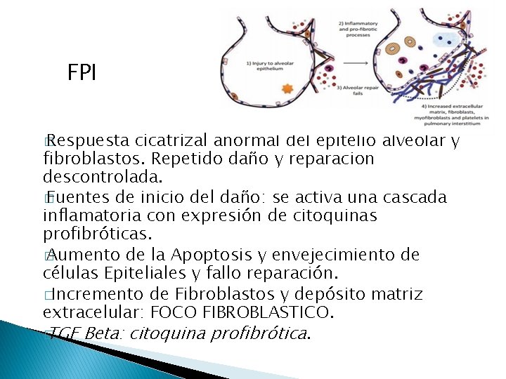 FPI � Respuesta cicatrizal anormal del epitelio alveolar y fibroblastos. Repetido daño y reparacion