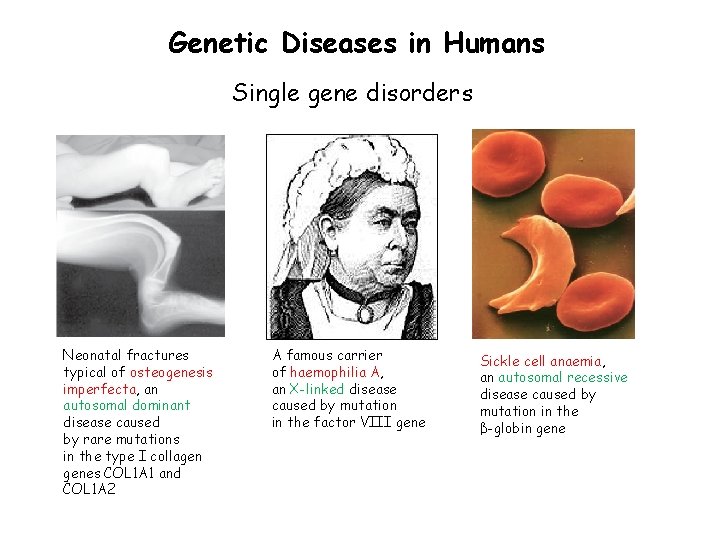Genetic Diseases in Humans Single gene disorders Neonatal fractures typical of osteogenesis imperfecta, an