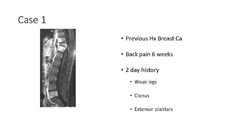 Case 1 • Previous Hx Breast Ca • Back pain 6 weeks • 2