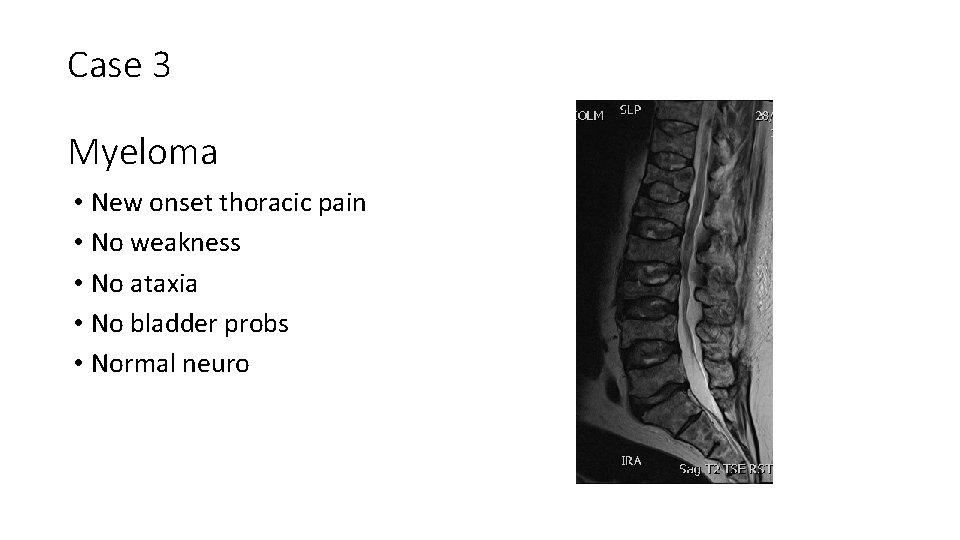 Case 3 Myeloma • New onset thoracic pain • No weakness • No ataxia