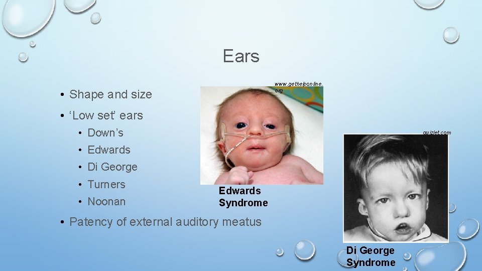 Ears www. gethelponline. org • Shape and size • ‘Low set’ ears • Down’s