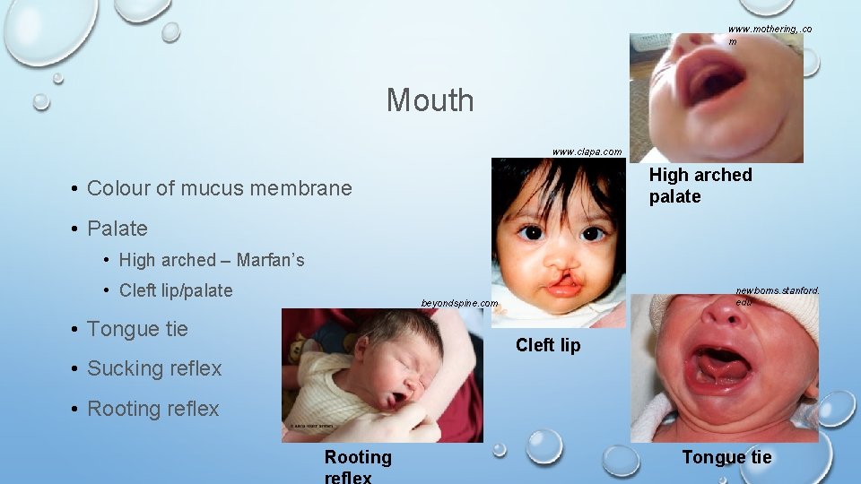 www. mothering, . co m Mouth www. clapa. com High arched palate • Colour