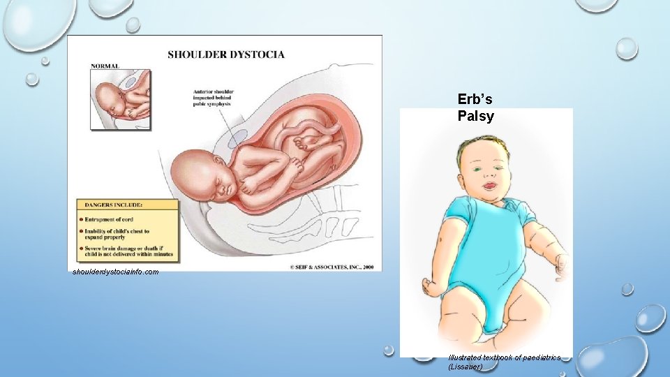 Erb’s Palsy shoulderdystociainfo. com Illustrated textbook of paediatrics (Lissauer) 