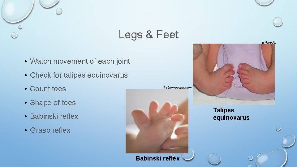 Legs & Feet wikipedia • Watch movement of each joint • Check for talipes