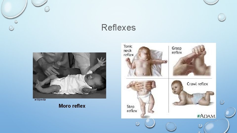 Reflexes wikipedia Moro reflex 