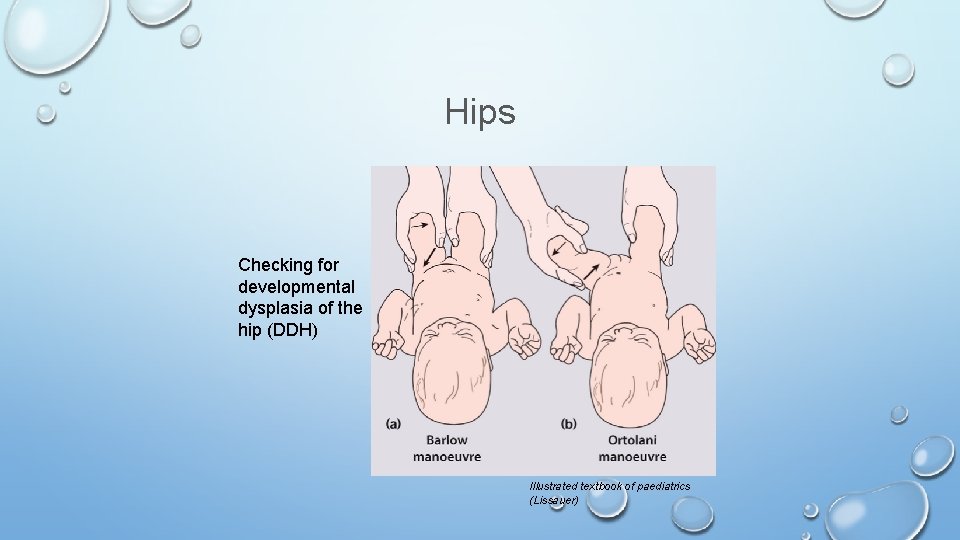 Hips Checking for developmental dysplasia of the hip (DDH) Illustrated textbook of paediatrics (Lissauer)