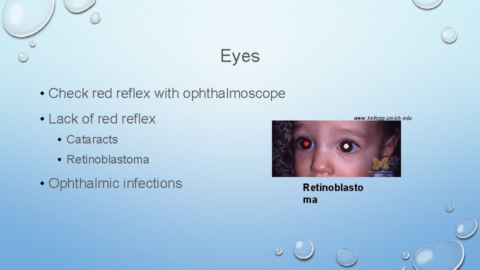 Eyes • Check red reflex with ophthalmoscope • Lack of red reflex www. kellogg.