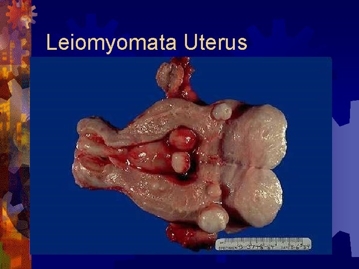 Leiomyomata Uterus 