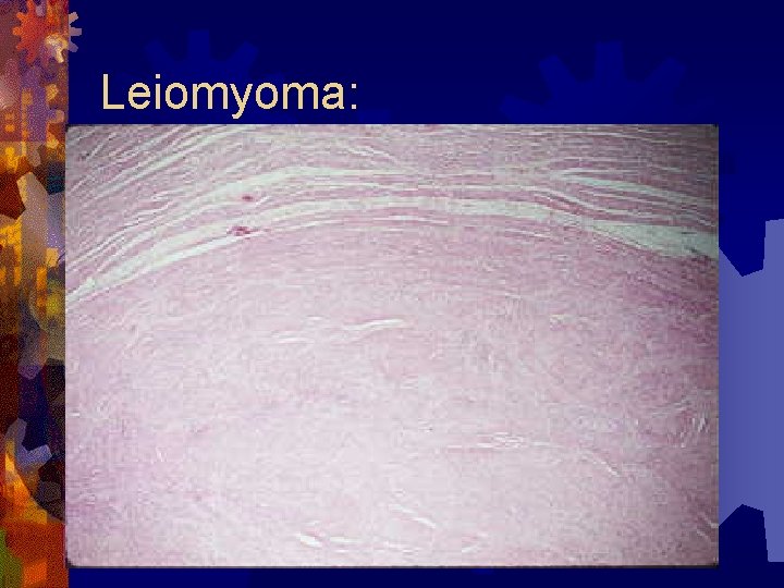 Leiomyoma: 