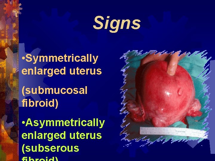 Signs • Symmetrically enlarged uterus (submucosal fibroid) • Asymmetrically enlarged uterus (subserous 