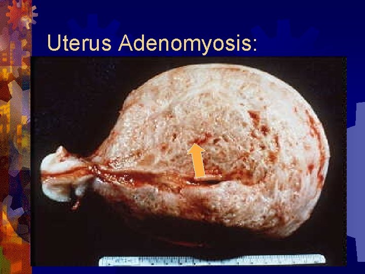 Uterus Adenomyosis: 