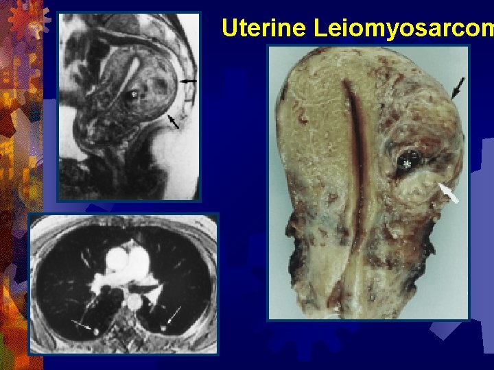 Uterine Leiomyosarcom 