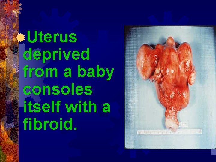 ®Uterus deprived from a baby consoles itself with a fibroid. 