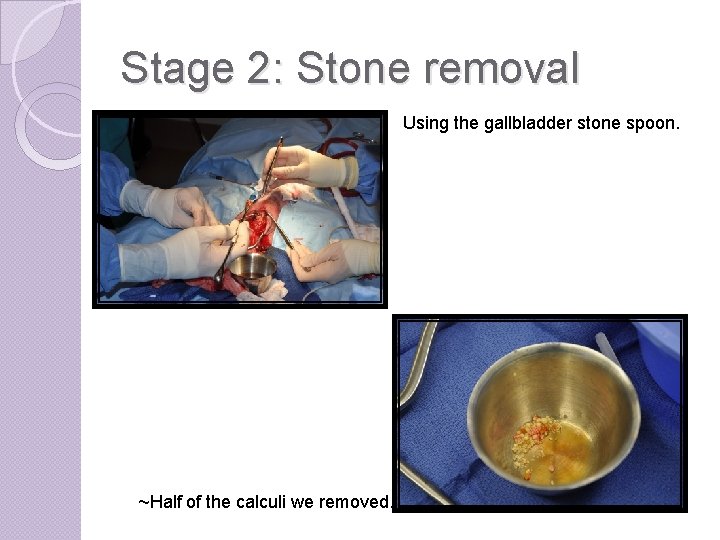 Stage 2: Stone removal Using the gallbladder stone spoon. ~Half of the calculi we