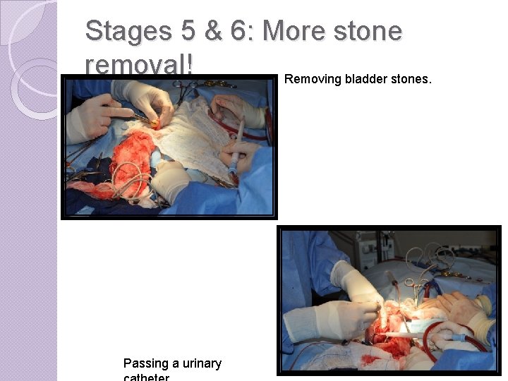 Stages 5 & 6: More stone removal! Removing bladder stones. Passing a urinary 