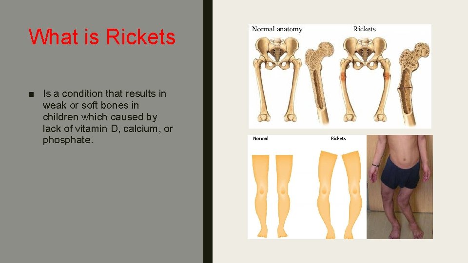 What is Rickets ■ Is a condition that results in weak or soft bones