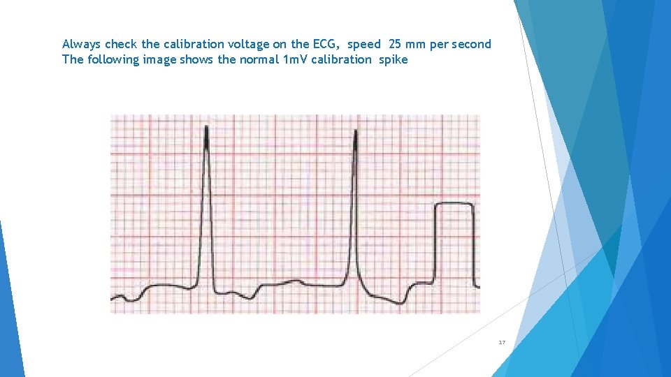 Always check the calibration voltage on the ECG, speed 25 mm per second The