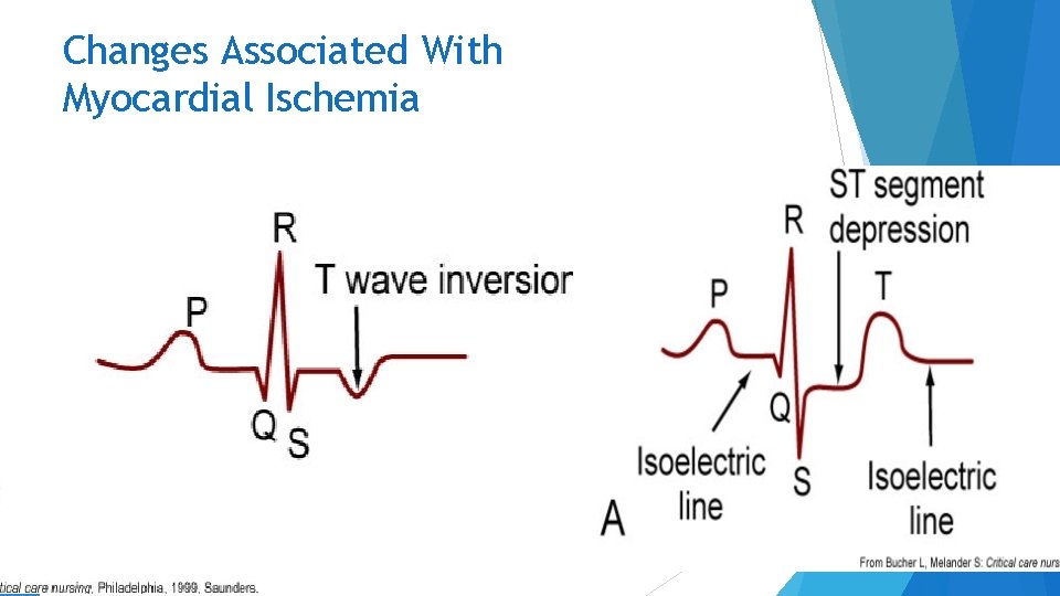 Changes Associated With Myocardial Ischemia Copyright © 2014 by Mosby, an imprint of Elsevier
