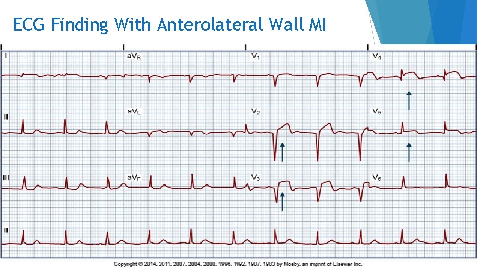 ECG Finding With Anterolateral Wall MI Copyright © 2014 by Mosby, an imprint of