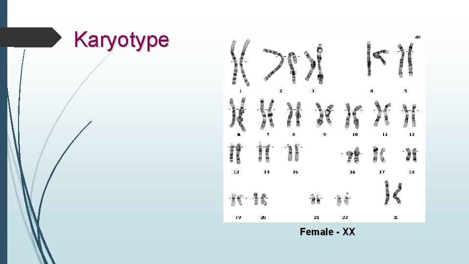 Karyotype Female - XX 