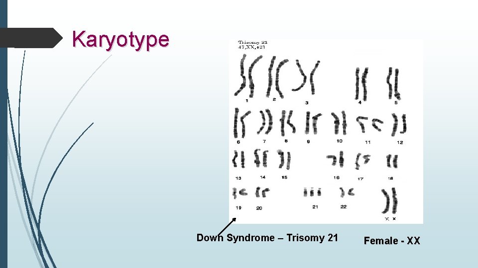 Karyotype Down Syndrome – Trisomy 21 Female - XX 
