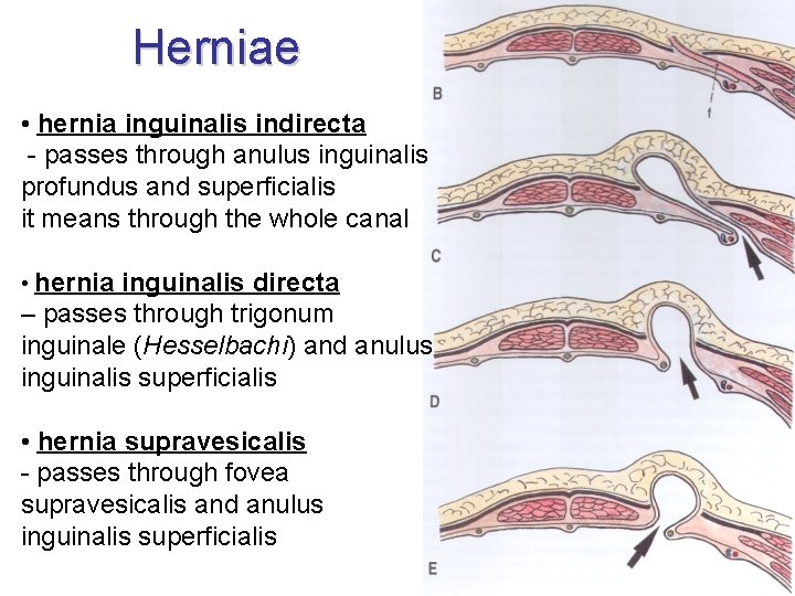 Herniae • hernia inguinalis indirecta - passes through anulus inguinalis profundus and superficialis it