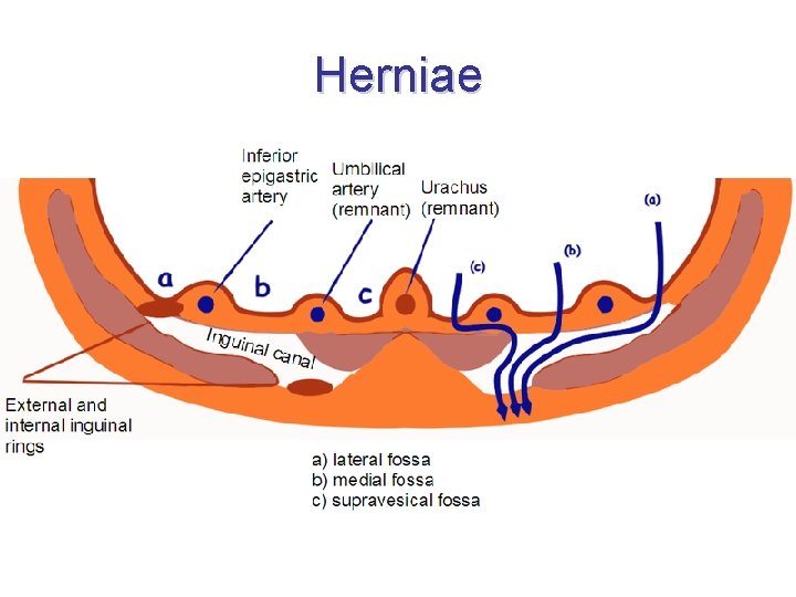 Herniae 