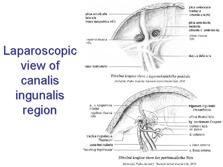 Laparoscopic view of canalis ingunalis region 