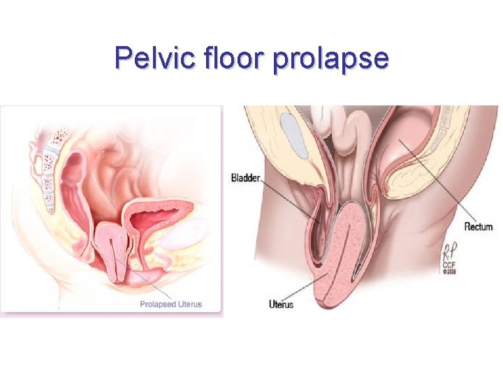 Pelvic floor prolapse 