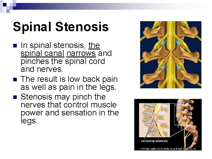 Spinal Stenosis n n n In spinal stenosis, the spinal canal narrows and pinches