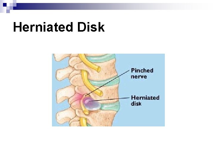 Herniated Disk 