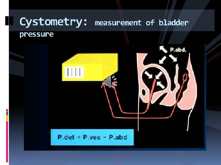 Cystometry: pressure measurement of bladder 