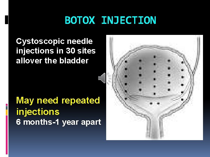 BOTOX INJECTION Cystoscopic needle injections in 30 sites allover the bladder May need repeated