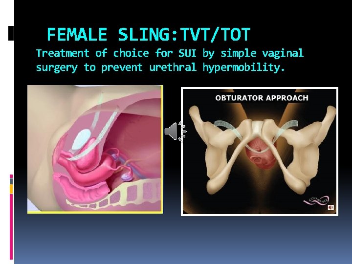 FEMALE SLING: TVT/TOT Treatment of choice for SUI by simple vaginal surgery to prevent