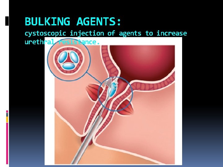 BULKING AGENTS: cystoscopic injection of agents to increase urethral resistance. 