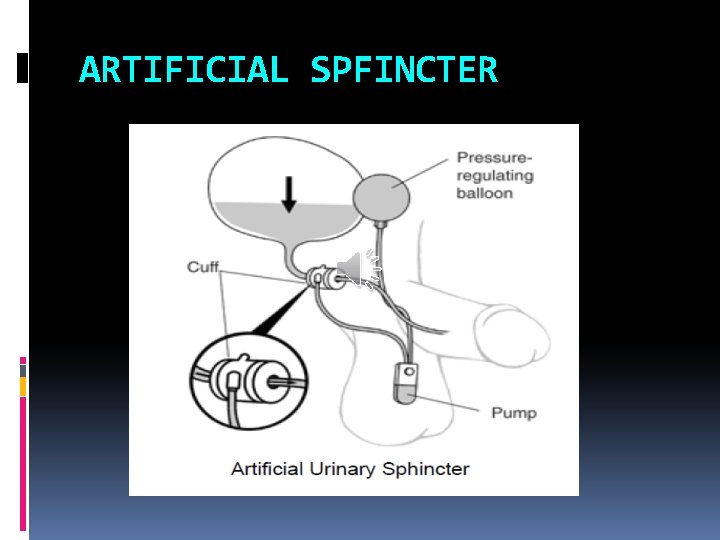 ARTIFICIAL SPFINCTER 