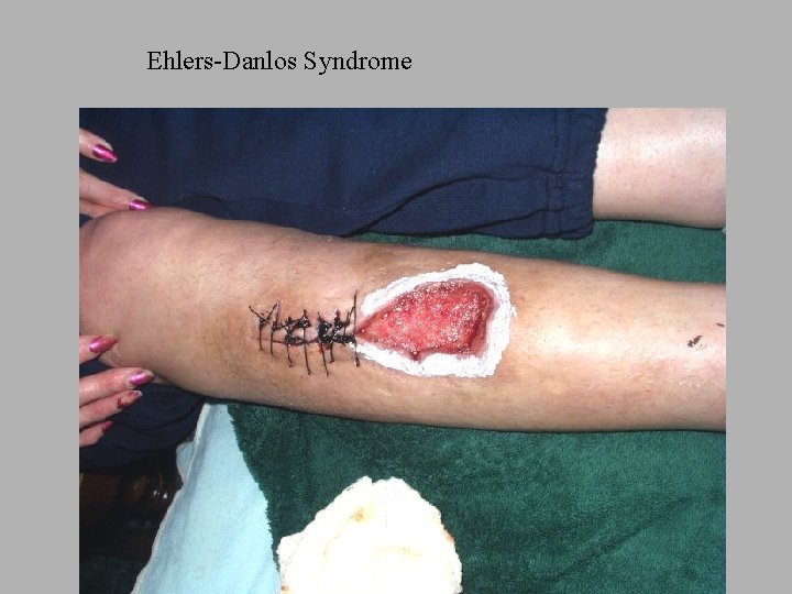 Ehlers-Danlos Syndrome 