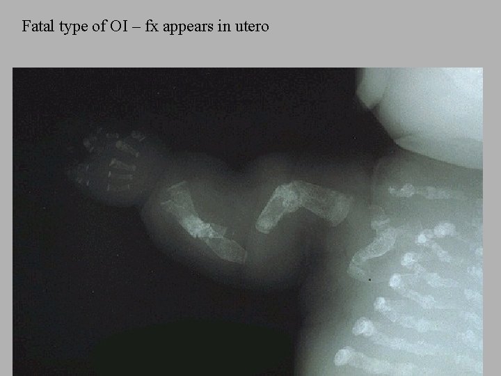 Fatal type of OI – fx appears in utero 