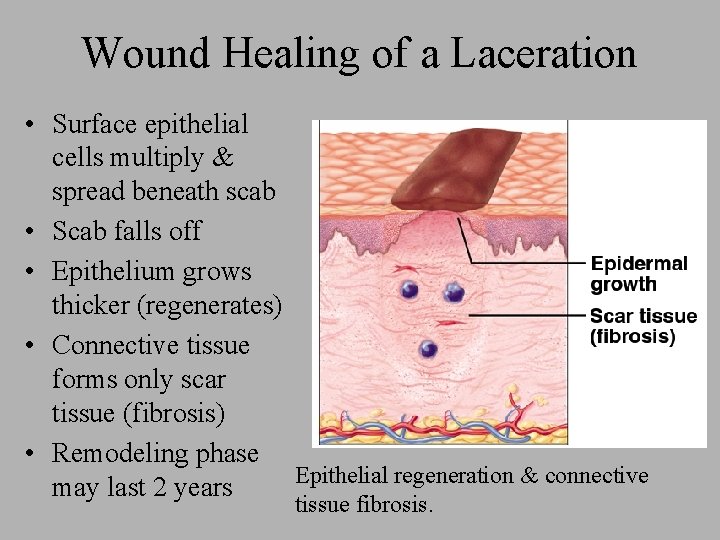 Wound Healing of a Laceration • Surface epithelial cells multiply & spread beneath scab