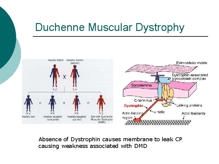 Duchenne Muscular Dystrophy Absence of Dystrophin causes membrane to leak CP causing weakness associated