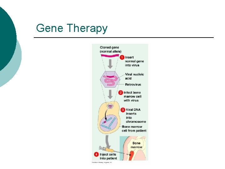Gene Therapy 