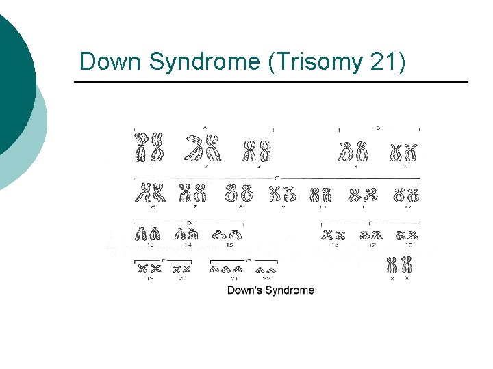 Down Syndrome (Trisomy 21) 