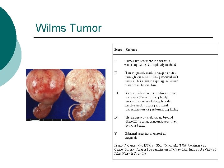 Wilms Tumor 