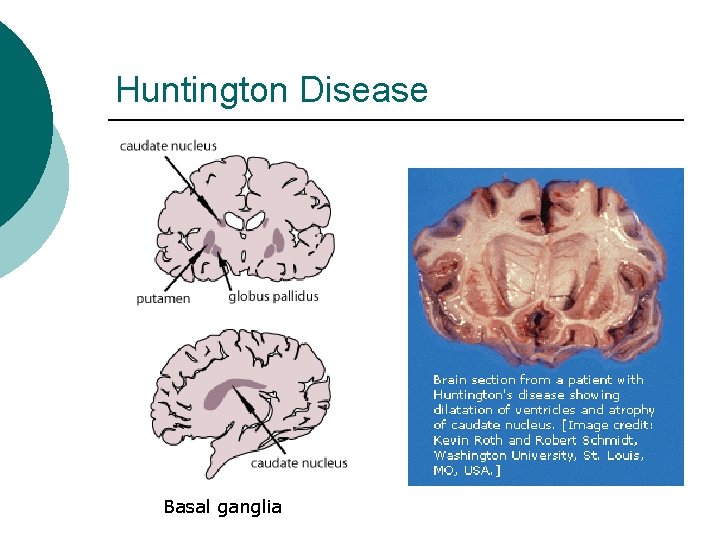 Huntington Disease Basal ganglia 