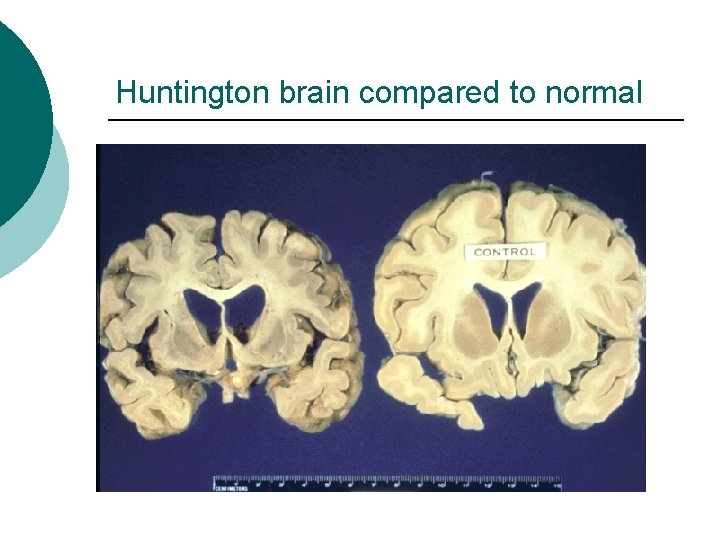 Huntington brain compared to normal 