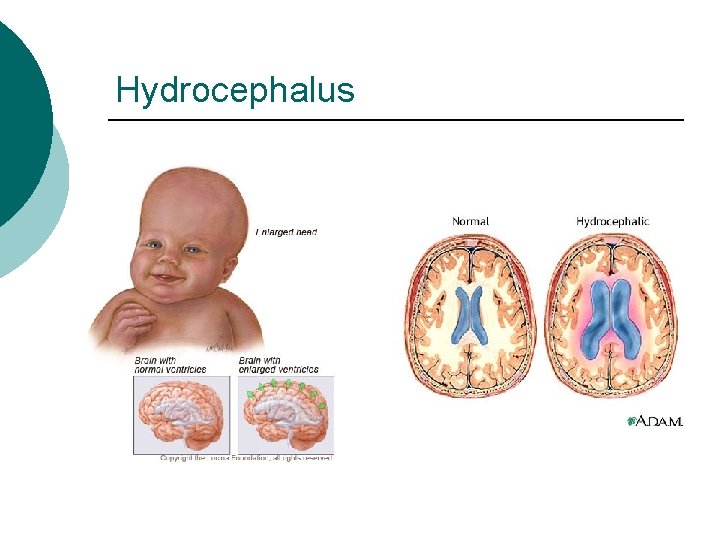 Hydrocephalus 