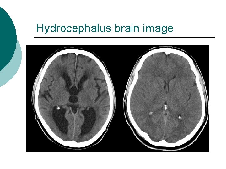 Hydrocephalus brain image 